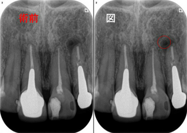 根尖病変による垂直的な骨吸収とMTA根管充填 と治癒過程 - EE DENTAL_Blog